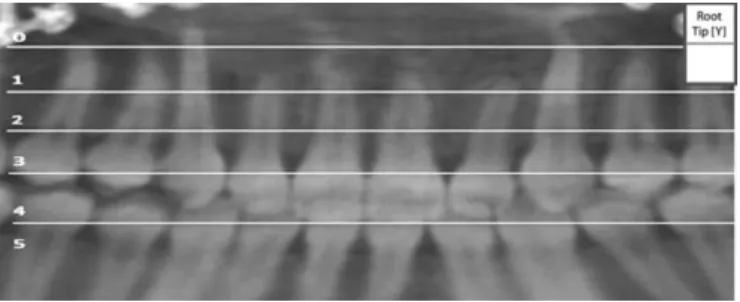Figure 7 : Scores dans la dimension transversale 25 0 : la pointe canine / l’apex est bien situé(e) sur l’arcade en vue occlusale 