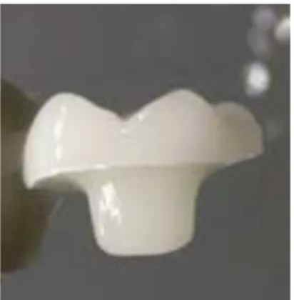 Figure 1 : Préparation d’une dent pour  endocouronne réalisée au centre de soins dentaires 