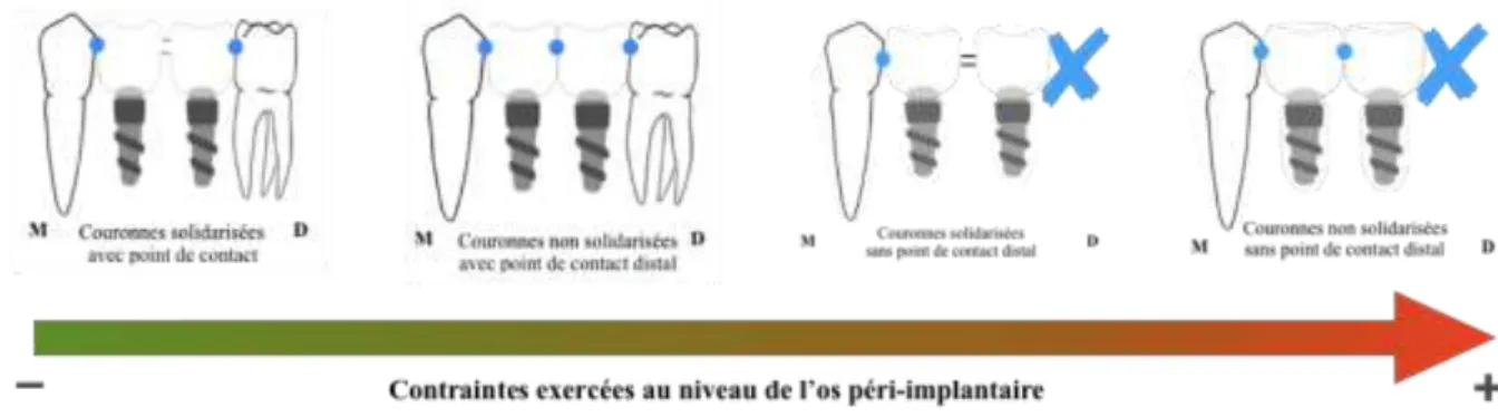 Figure 7 : Répartition des contraintes sur l’os péri-implantaire par rapport à la présence d’une dent  bordant l’édentement 