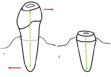 Figure 2 : Réduction des forces de flexion via la réduction coronaire 