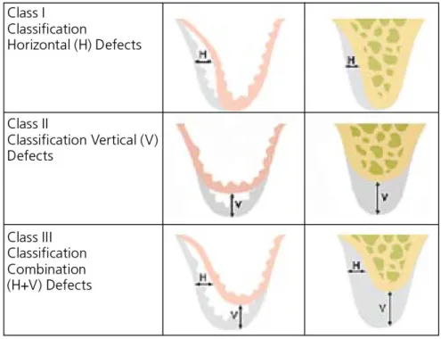 Figure 2 : Classification de Wang et Al-Shammari classant les défauts osseux selon leur sens et  sévérité  