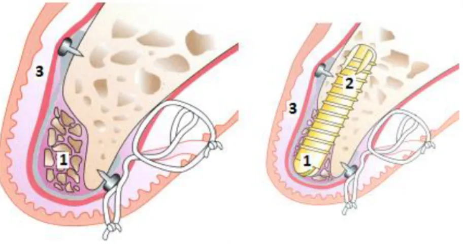 Figure 2 : Régénération osseuse guidée. 1 : greffe osseuse, 2 : implant, 3 : membrane séparant la  muqueuse de recouvrement de la greffe maintenue par des vis 