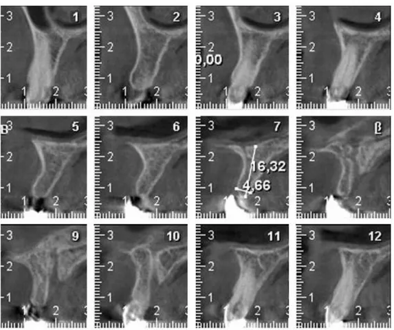 Figure 4 : Examen radiologique montrant la perte osseuse horizontale ne permettant pas la pose  d’implant