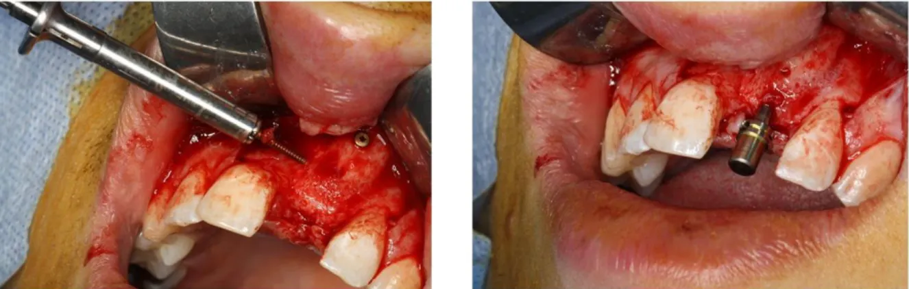 Figure 16 : Dépose des vis puis mise en place de l’implant 