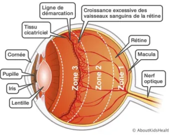 Figure 7 : Schéma illustrant la rétinopathie 