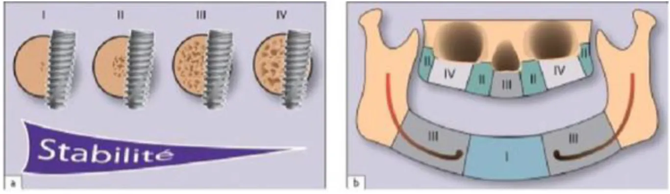 Figure 4 : a. Schématisation des quatre types osseux en fonction de la stabilité primaire de l’implant  b