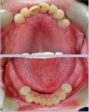 Figure 12 : Xérostomie due à la radiothérapie 