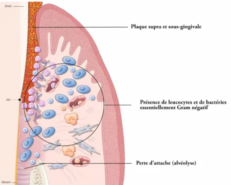 Figure 3 – Lésion avancée : parodontite (Bouchard P. et al., 2014) 