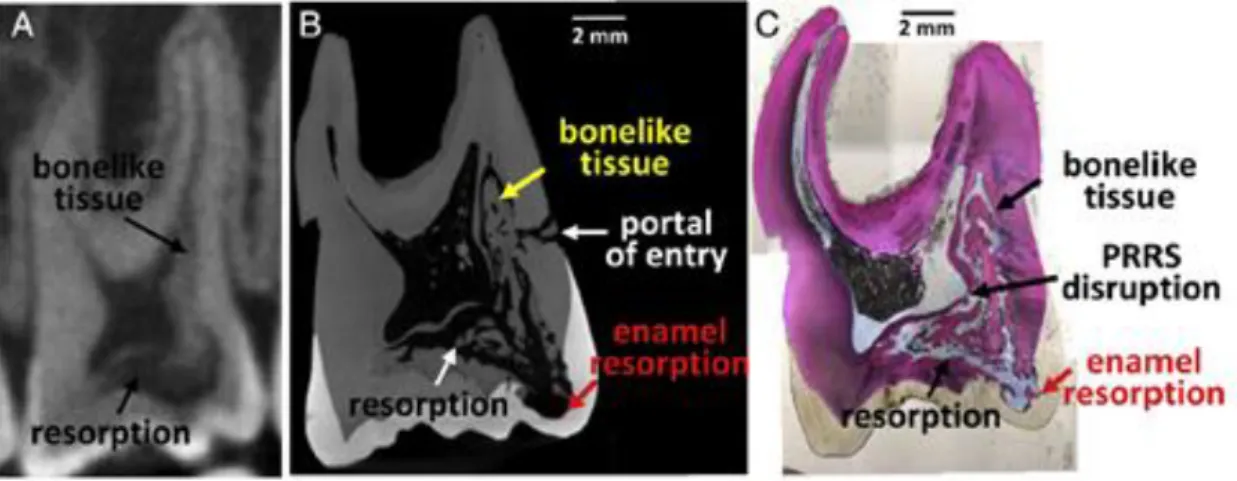 Figure 3 : Image CBCT (A), nano-CT (B) et coupe histologique (C) d'une dent atteinte de RCE