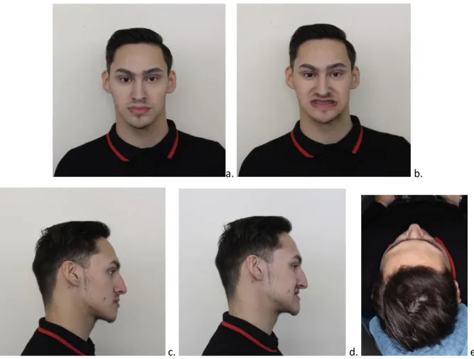 Figure 5 : Photographies exobuccales du visage de face (a) Face neutre ; (b) Face sourire ; (c) Profil  neutre ; (d) Profil sourire ; (e) Vue du crâne de haut 