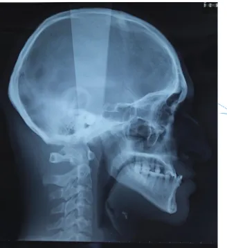 Figure 13 : Téléradiographie de profil et analyse de Tweed de Alexandre 