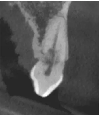 Figure 6 : Coupe Vestibulo-linguale  de CBCT mettant en évidence une forme de réparation  osseuse  s’invaginant dans la dent