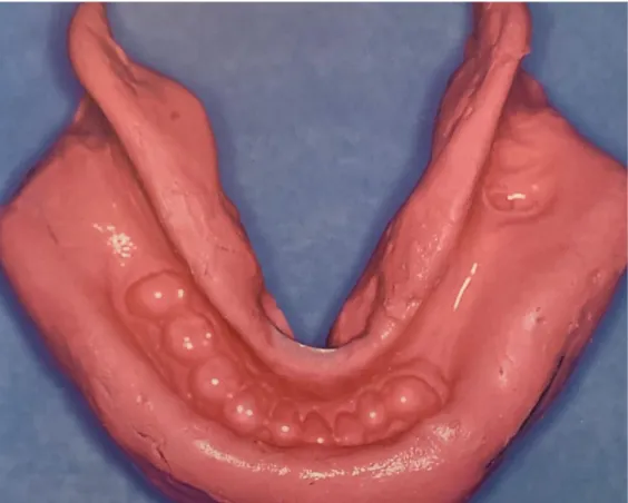 Figure 13 : Empreinte primaire à l’alginate 