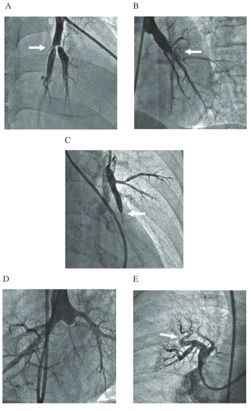 Figure 2 ± Angiographies pulmonaires sélectives GDQVO¶+7$3SRVW-embolique 28                      A                                                       B                                                      