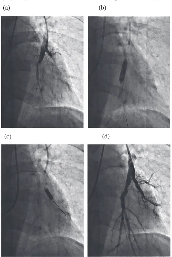 Figure 3. Angiographies pulmonaires sélectives DXFRXUVG¶XQHSURFpGXUHG¶Dngioplastie pulmonaire 49