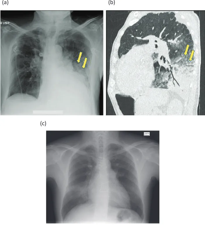 Figure 4. Complications possibles au cours des angioplasties pulmonaires 49