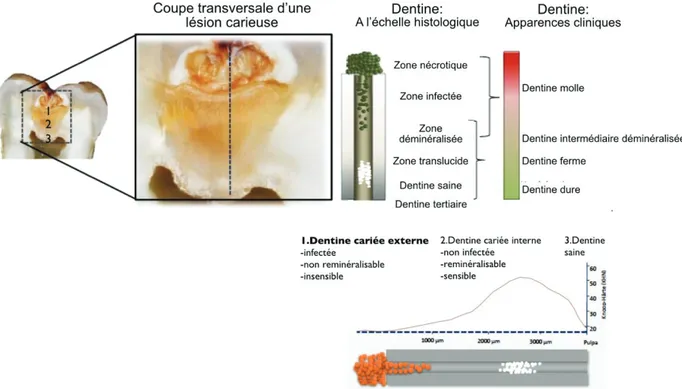 Tableau I : Aspects cliniques des différents types de dentines observés au niveau des  lésions carieuses dentinaires (4) 