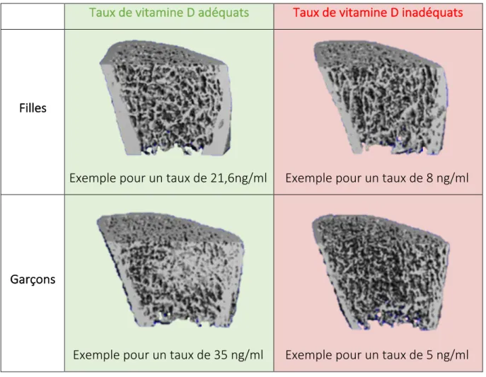 Figure   4   :   Comparaison   de   l’aspect   de   l’os   sous   HR-­‐pQCT   (High   Resolution   Quantitative    Computer   Tomography)   de   garçons   et   filles   selon   leur   taux   sérique   de   vitamine   D   