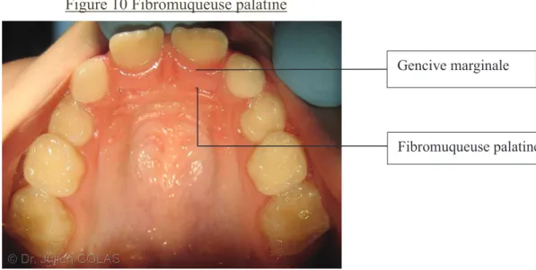 Figure 10 Fibromuqueuse palatine 