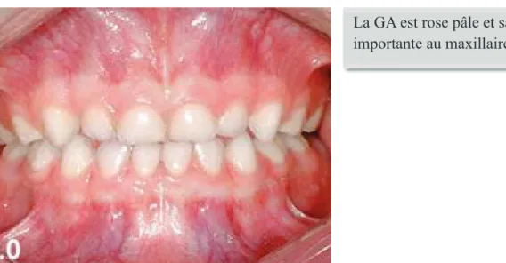 Figure 15 Denture temporaire stable 