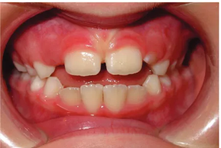Figure 16 Etablissement de la denture mixte 