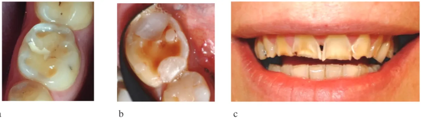 Figure 15: Patient bruxeur présentant de lésions cervicales d’usure sur les  dents 23 et 33 (Dr E