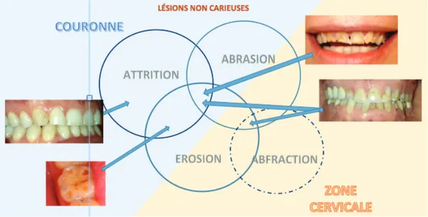 Figure 16 : Schéma représentant les différents phénomènes d’usures pouvant se combiner, comme l’attrition,  l’abrasion et l’érosion