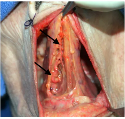Figure 2: Dissection de la langue montrant le trajet de l’artère profonde de la langue (injection latex rouge)