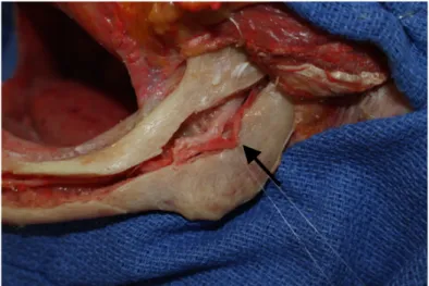 Figure 6: Artère alvéolaire inférieure cheminant dans son canal. Une ostéotomie mandibulaire a été réalisée pour visualiser  le canal alvéolaire