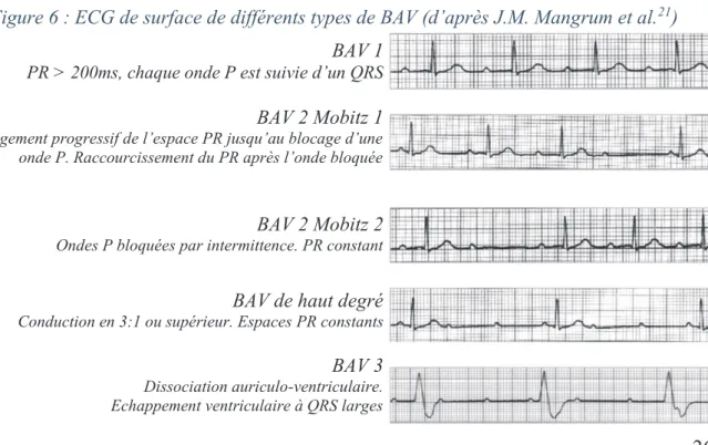 Figure 6 : ECG de surface de différents types de BAV (d’après J.M. Mangrum et al. 21 )  BAV 1 