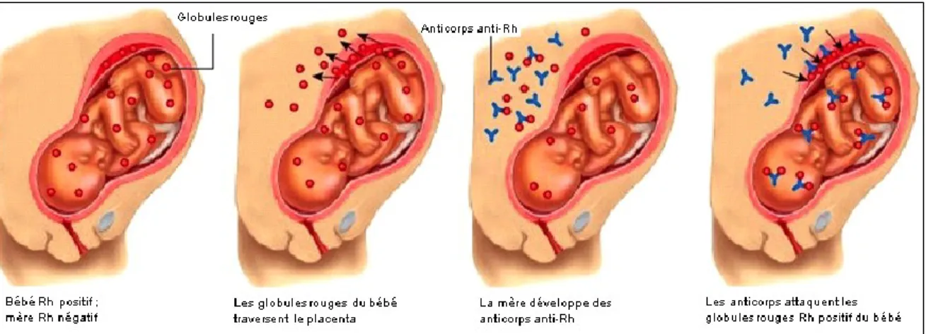 Figure 1.2. : Processus qui mène à la maladie hémolytique du nouveau-né causée par des anticorps anti-D