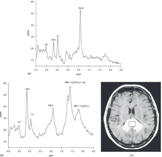 Figure 14. IRM  de spectroscopie d'un  lymphome primitif cérébral. (a) profil métabolique normal d'un  volontaire sain