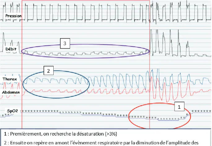 Figure 4: Exemple de polygraphie sous VNI : obstruction sans diminution de la commande ventilatoire