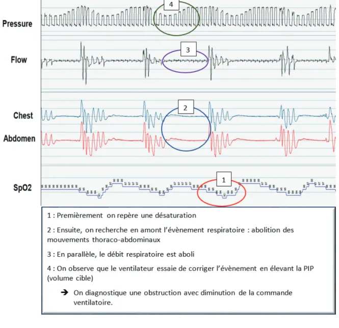 Figure 1: Exemple de polygraphie sous VNI : obstruction avec diminution de la commande ventilatoire 