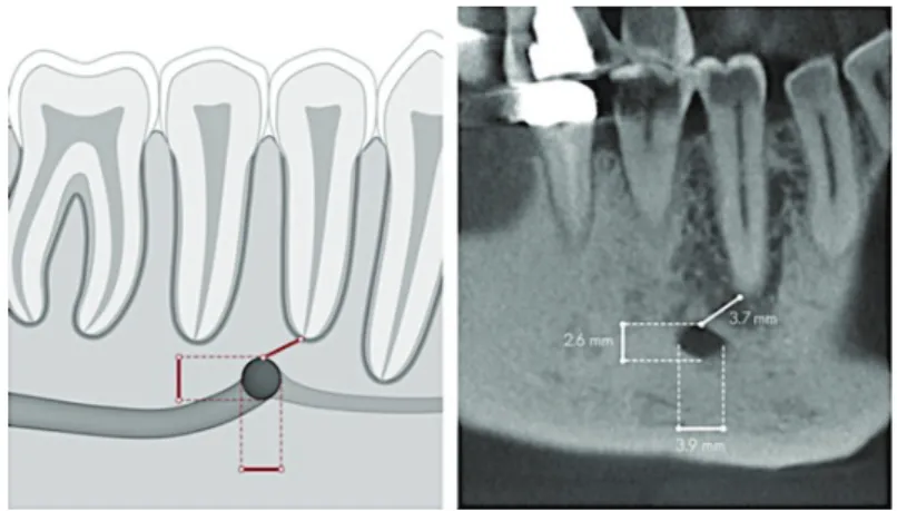 Figure n° 13 : Illustrations schématique et radiographique de la position du foramen mentonnier 