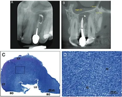 Figure n° 30 : Radiographies et Coupes histologiques d’un granulome non épithélialisé associé à  l’apex d’une incisive latérale maxillaire gauche