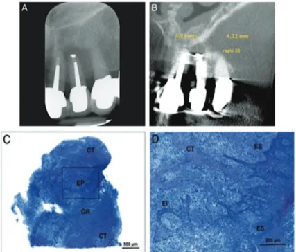 Figure n° 31 : Radiographies et Coupes histologiques d’un granulome épithélialisé associé à l’apex  d’une incisive latérale maxillaire gauche