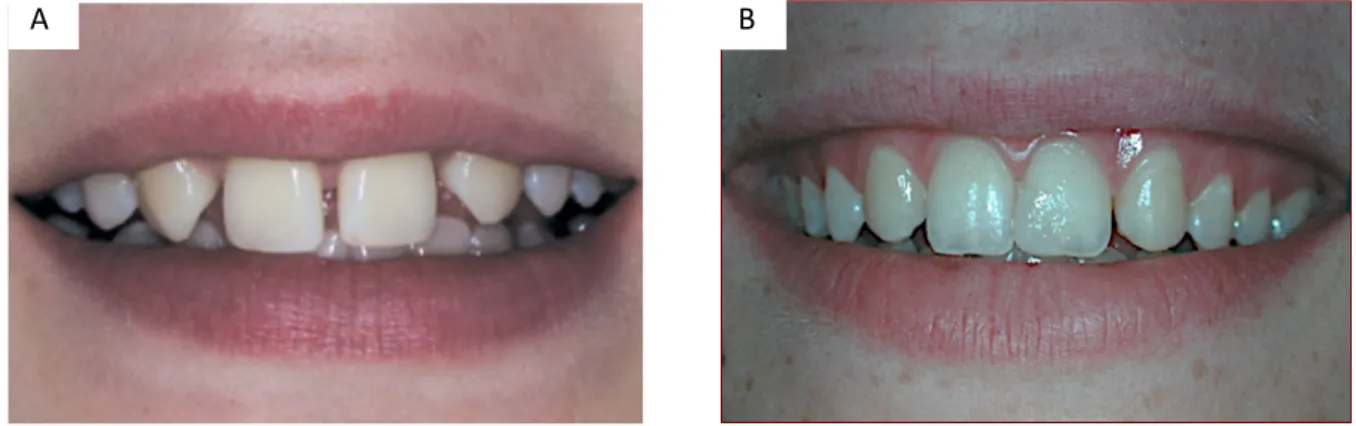 Figure 9 : A. ligne du sourire en position moyenne (Kokich VO. 2005) ; B. ligne du sourire haute  avec exposition de la hauteur de la dent ainsi que la gencive (cas du Dr Oueiss A.) 