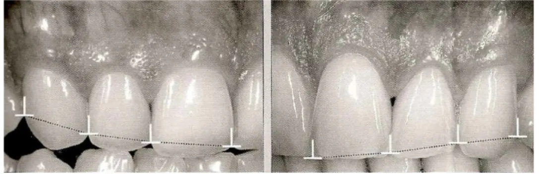 Figure 15 : Zone de contact apparente esthétique (Magne P. 2003) 