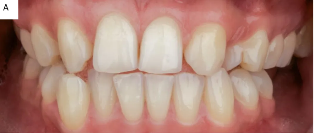 Figure 19 :  cas d’agénésie d’incisives latérales du Dr Cofar F. en 2014 : (A) avant  traitement ; (B) après traitement orthodontique par fermeture et facettes : la composition 