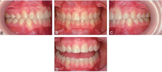 Figure 12 : Photographies intrabuccales d'un patient en classe I avec macrodontie des incisives mandibulaires (33) 
