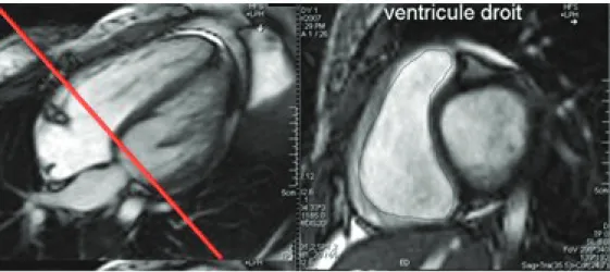Figure 8.  Etude du Ventricule droit en coupe petit axe à l’IRM cardiaque. In 2008 -  irmcardiaque.com 