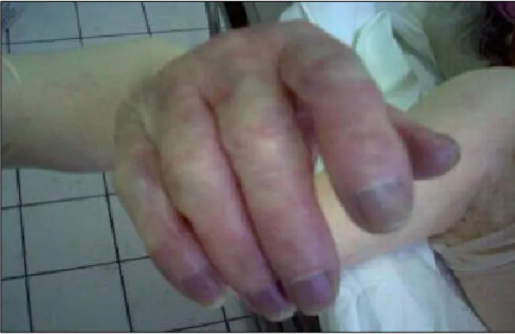 Figure 2 : Main sur laquelle on peut observer le phénomène de rigidité cadavérique : les  doigts présentent un aspect « crispé »