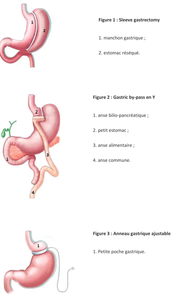 Figure 2 : Gastric by-pass en Y 