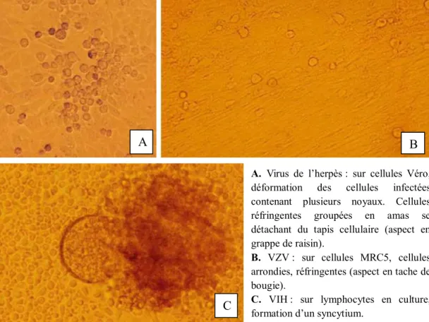 Figure 6. Effets cytopathogènes observés à l’état frais. (4) 