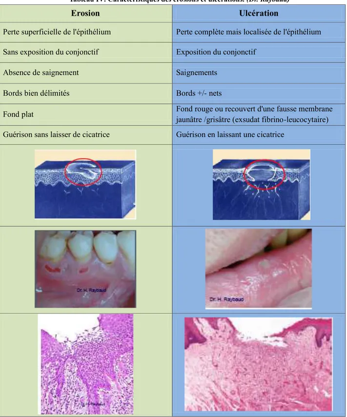 Tableau IV. Caractéristiques des érosions et ulcérations. (Dr. Raybaud) 