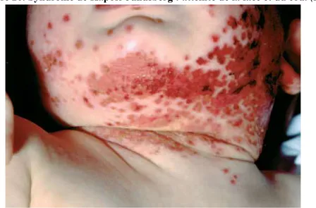 Figure 20. Syndrome de Kaposi-Juliusberg : atteinte de la face et du cou. (20) 