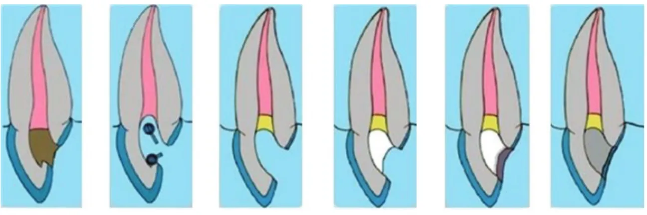 Figure 13 : Eclaircissement par technique « Inside / Outside » 38