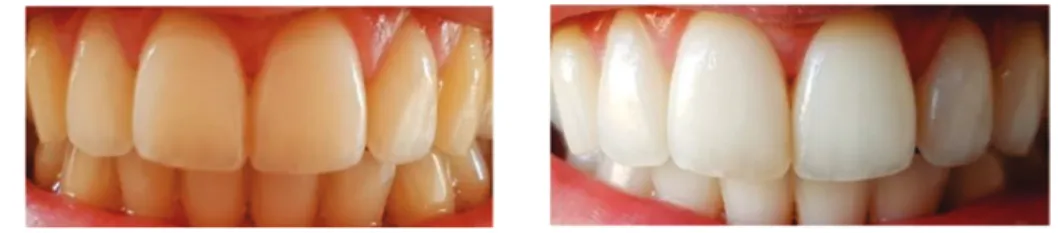 Figure 14 : Photographies avant / après éclaircissement dentaire 