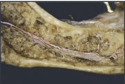 Figure 22. L’artère alvéolaire inférieure (injectée au latex) est en position supranerveuse